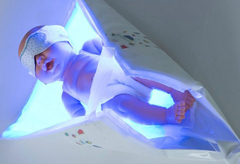 Neomedlight phototherapy for newborn babies